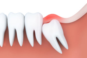 teeth extraction