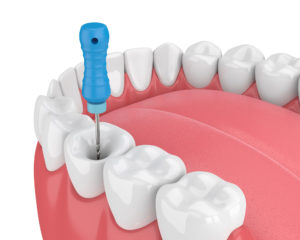 teeth back braces