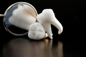 wisdom teeth surgery