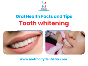 Tooth whitening